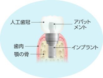 インプラント